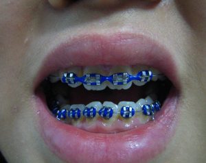 Image of a grimacing mouth showing a full set of braces.